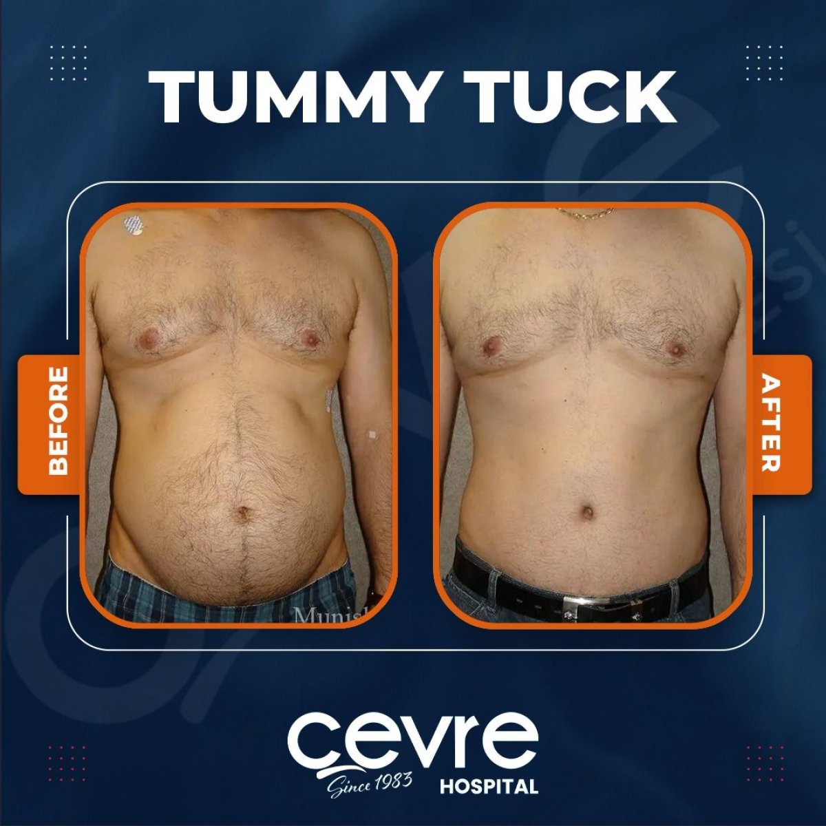 Résultats avant/après abdominoplastie à Cevre Hospital, amélioration du contour abdominal