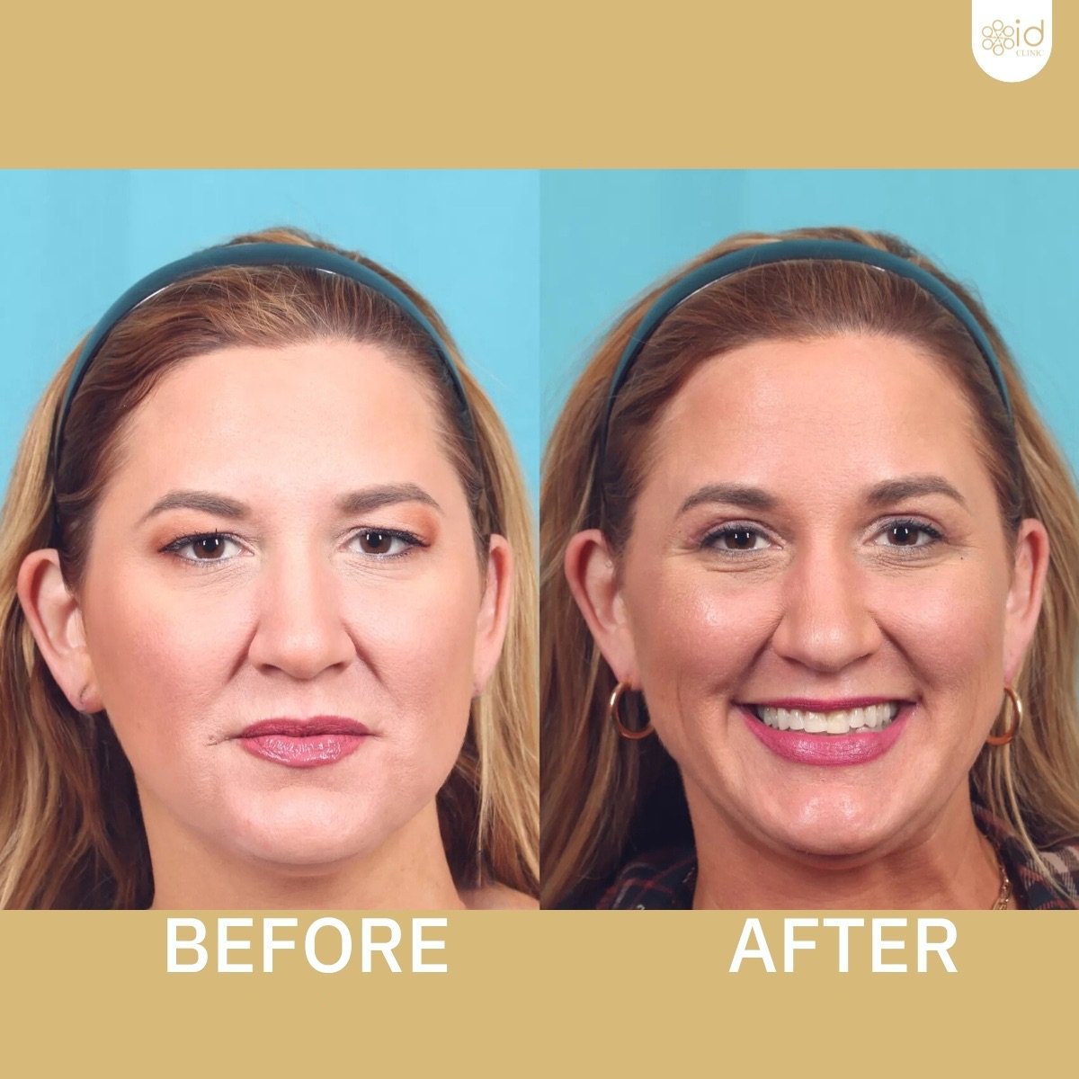 Before and after deep plane facelift results at ID Clinic Bangkok, facial rejuvenation outcome