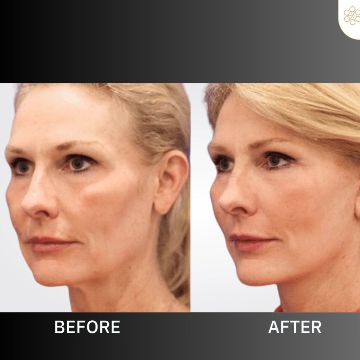 Before and after mini facelift results at ID Clinic Bangkok, visible facial rejuvenation