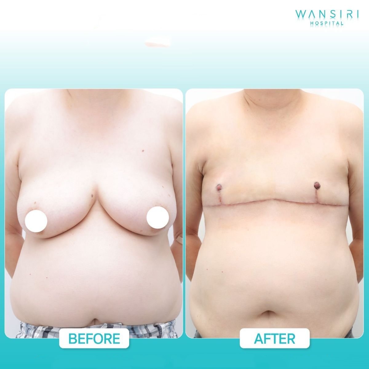 Resultados de top surgery antes y después en Wansiri Hospital, masculinización de tórax