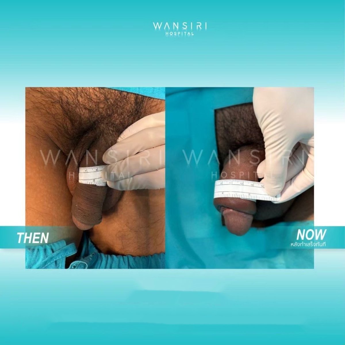 Before and after penis enlargement results at Wansiri Hospital, visible increase in girth