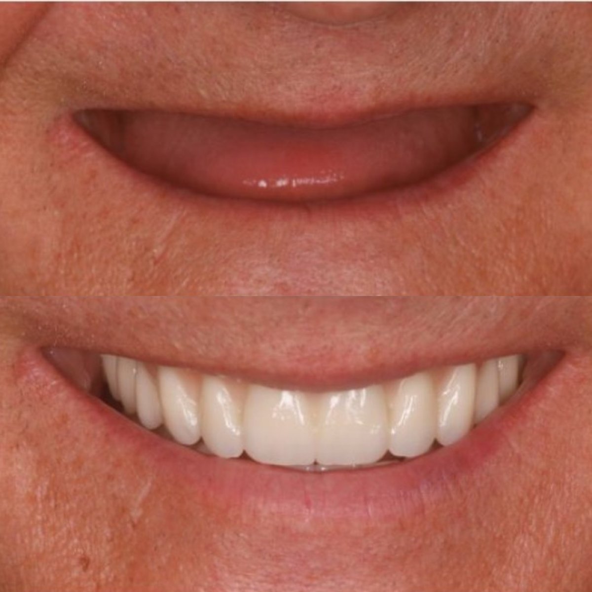 Before and after dental implant results at BMC Dental Klinik, restored full smile transformation