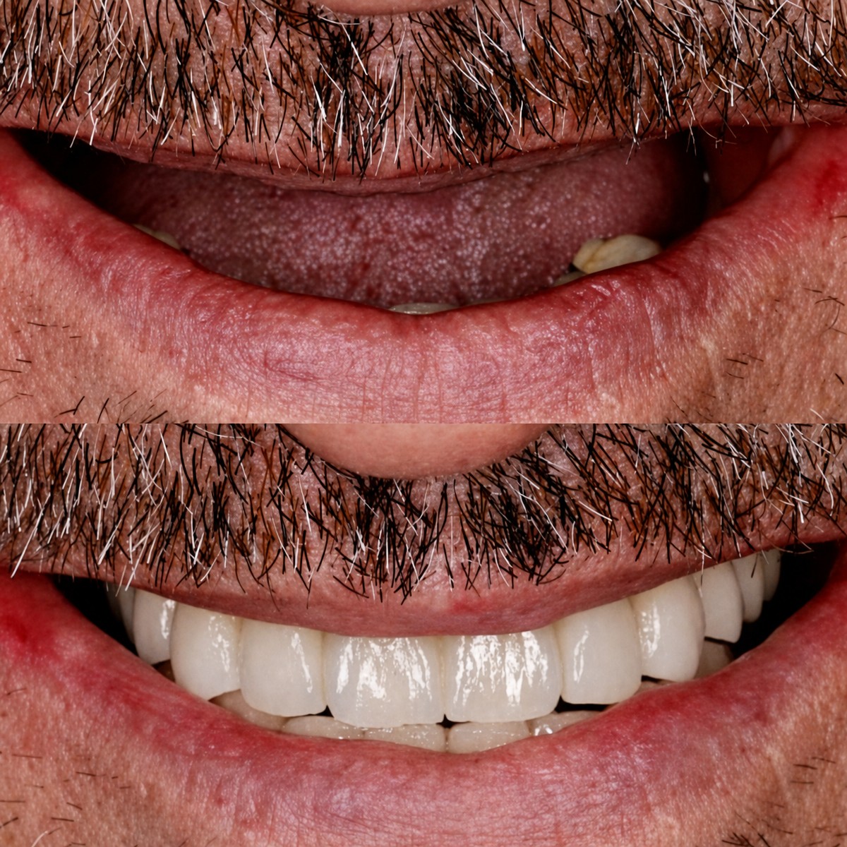 Before and after dental implant results at BMC Dental Klinik, restored smile and teeth