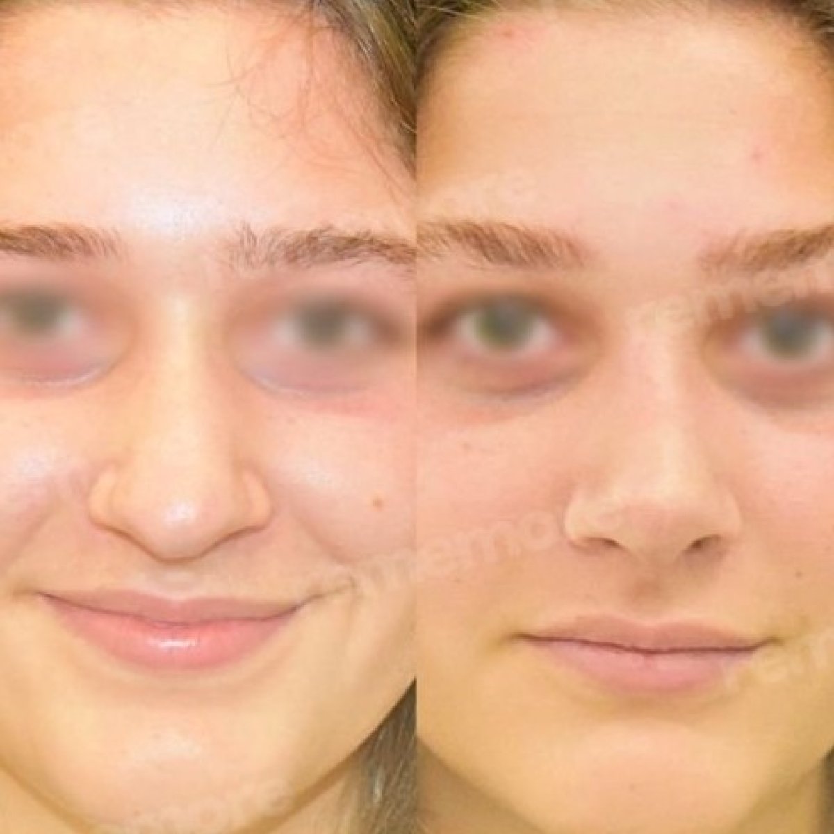 Resultados de rinoplastia antes y después en Memorial Ataşehir Hospital, remodelación nasal