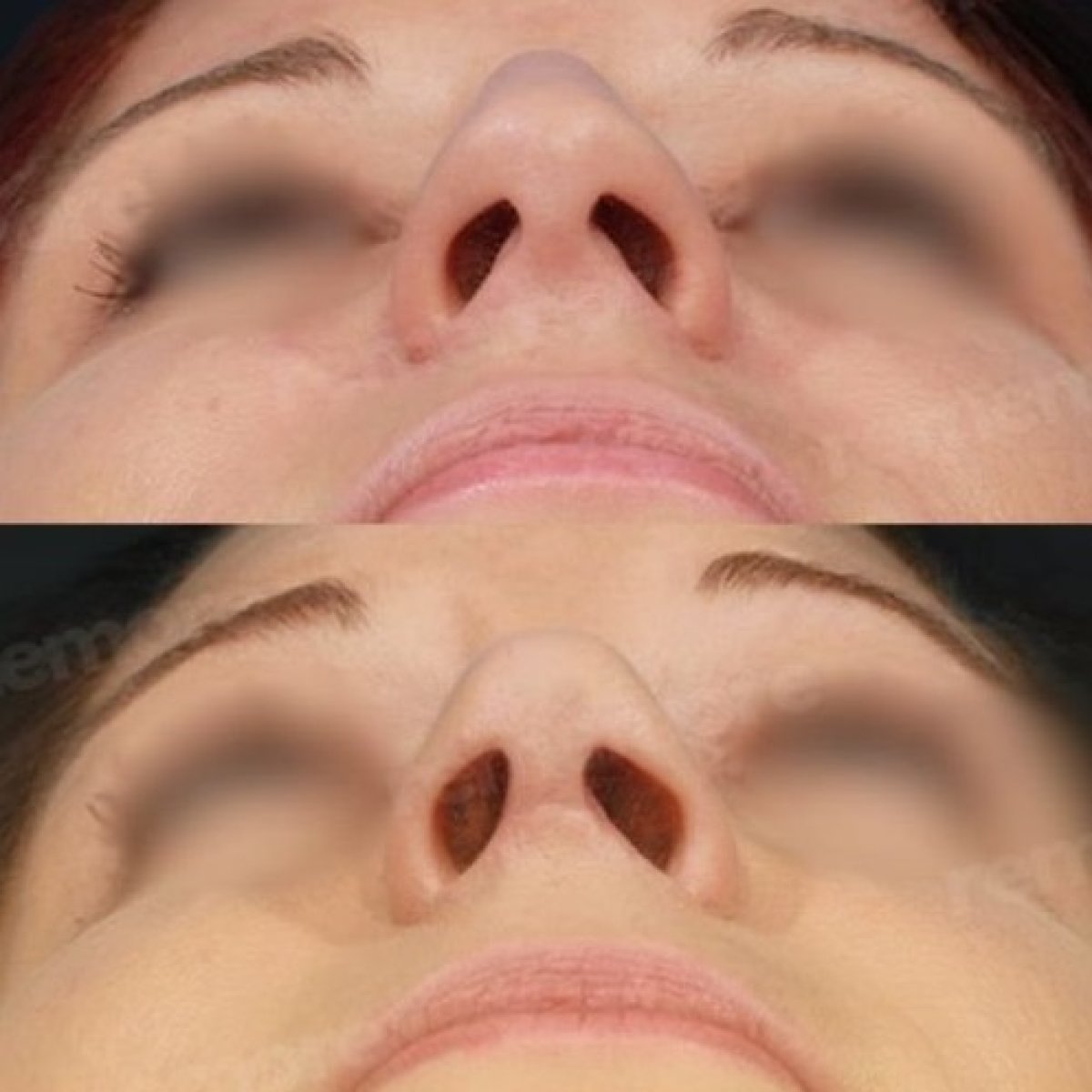 Resultados de rinoplastia antes y después en Memorial Ataşehir Hospital, forma de nariz mejorada