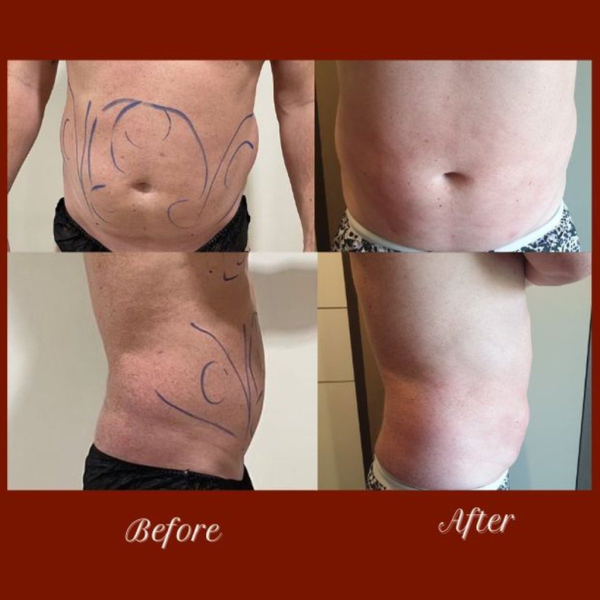 Résultats avant et après liposuccion à la DGB Clinic, amélioration du contour abdominal