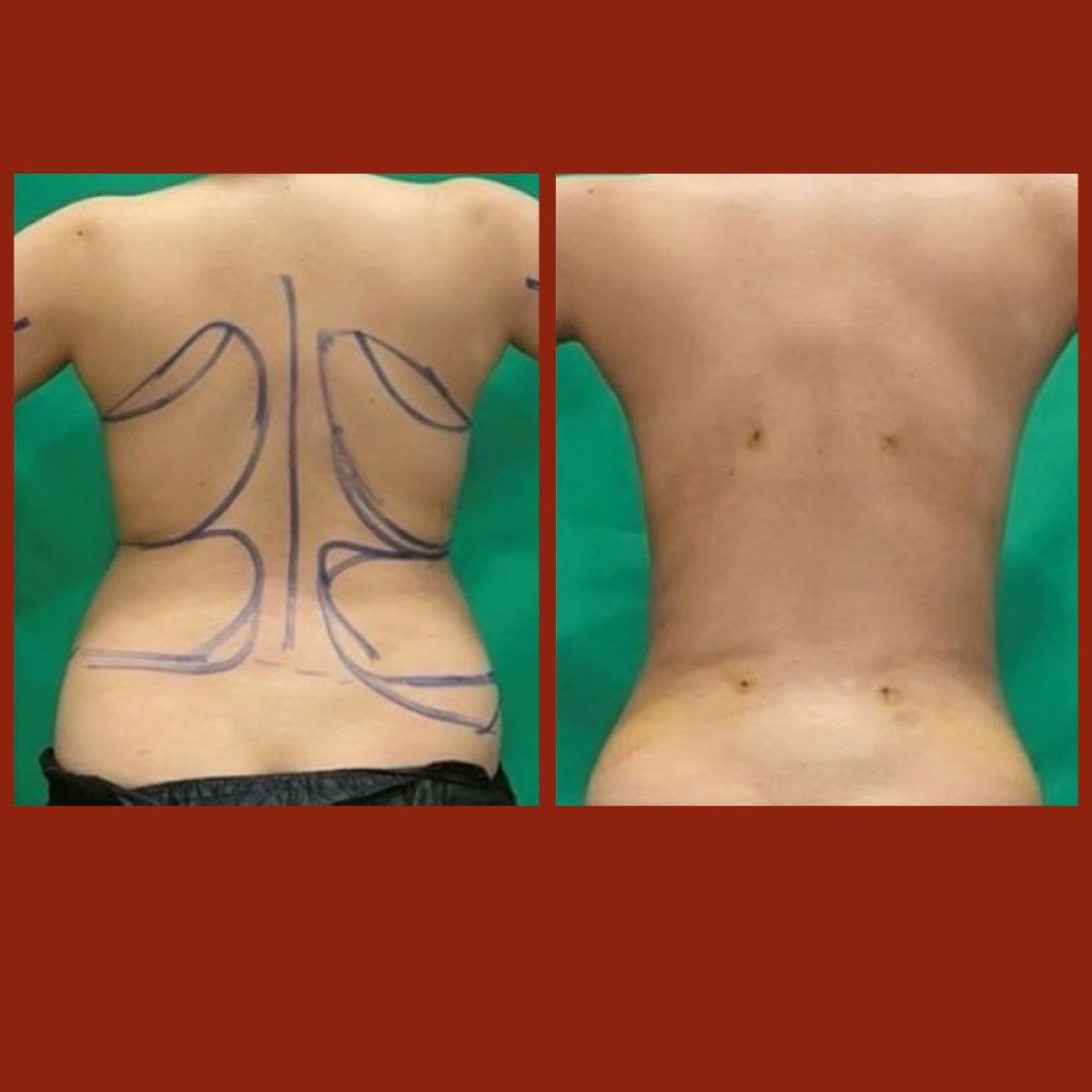 Resultados de liposucción antes y después en DGB Clinic, mejora visible del contorno de la espalda