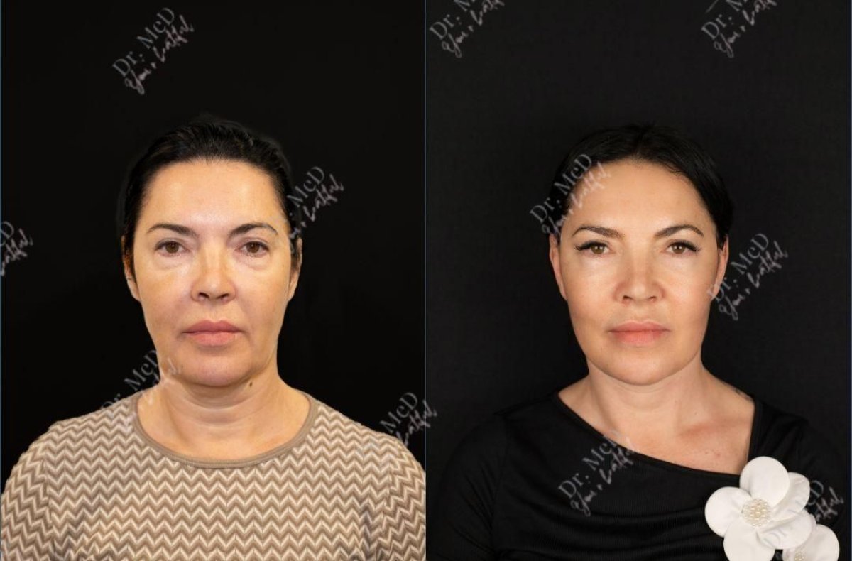 Résultats avant/après lipofilling visage chez Dr. MED – rajeunissement et restauration du volume