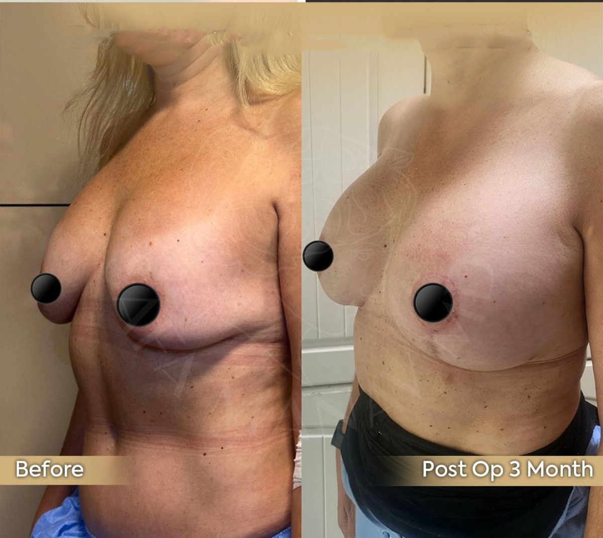 Resultados de lifting de senos antes y después en Dr. Safa Manav Clinic, mejora visible