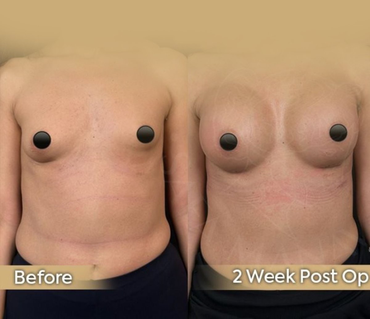 Before and after breast lift results at Dr. Safa Manav Clinic, improved breast contour visible