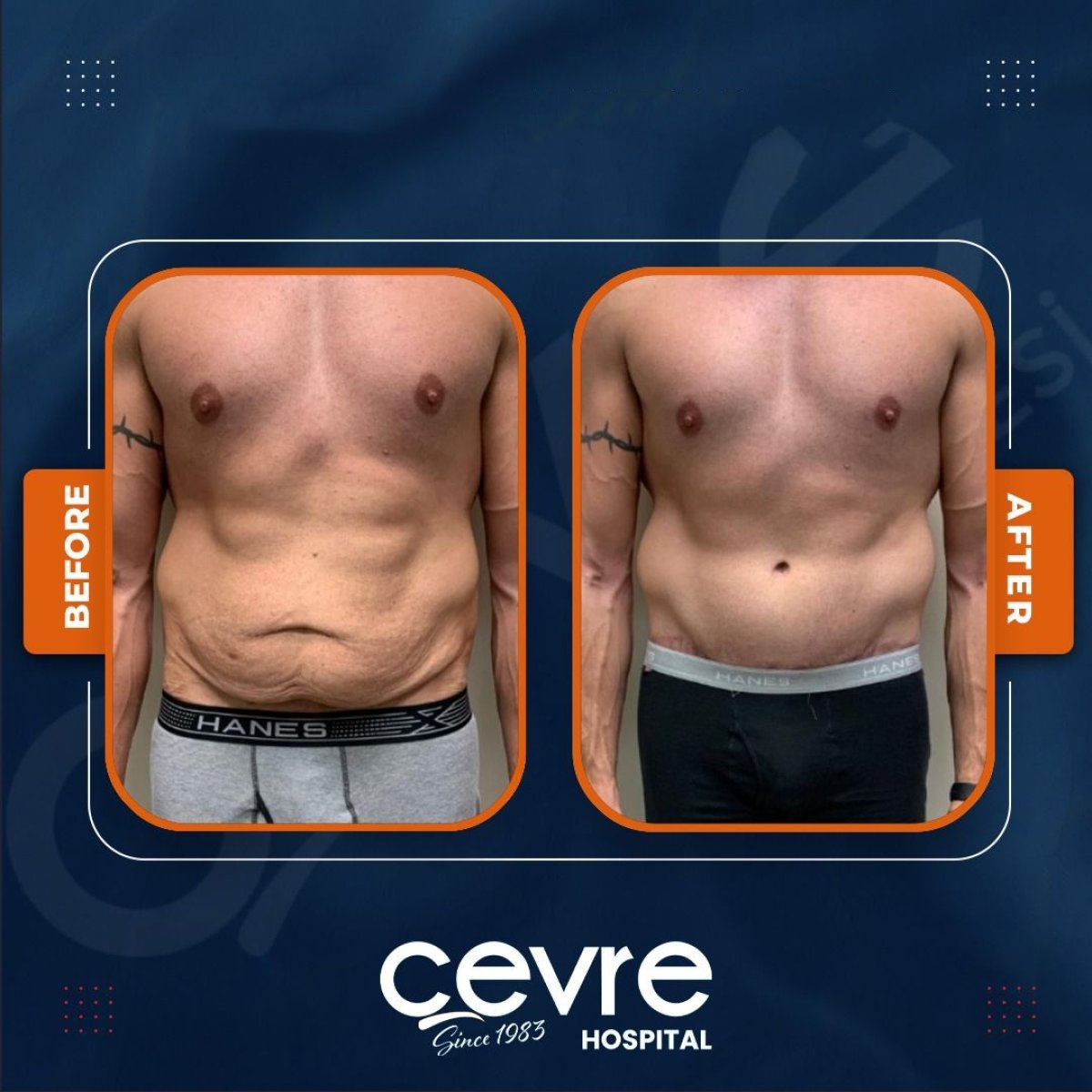 Before and after tummy tuck and liposuction results at Adem and Havva Medical Center