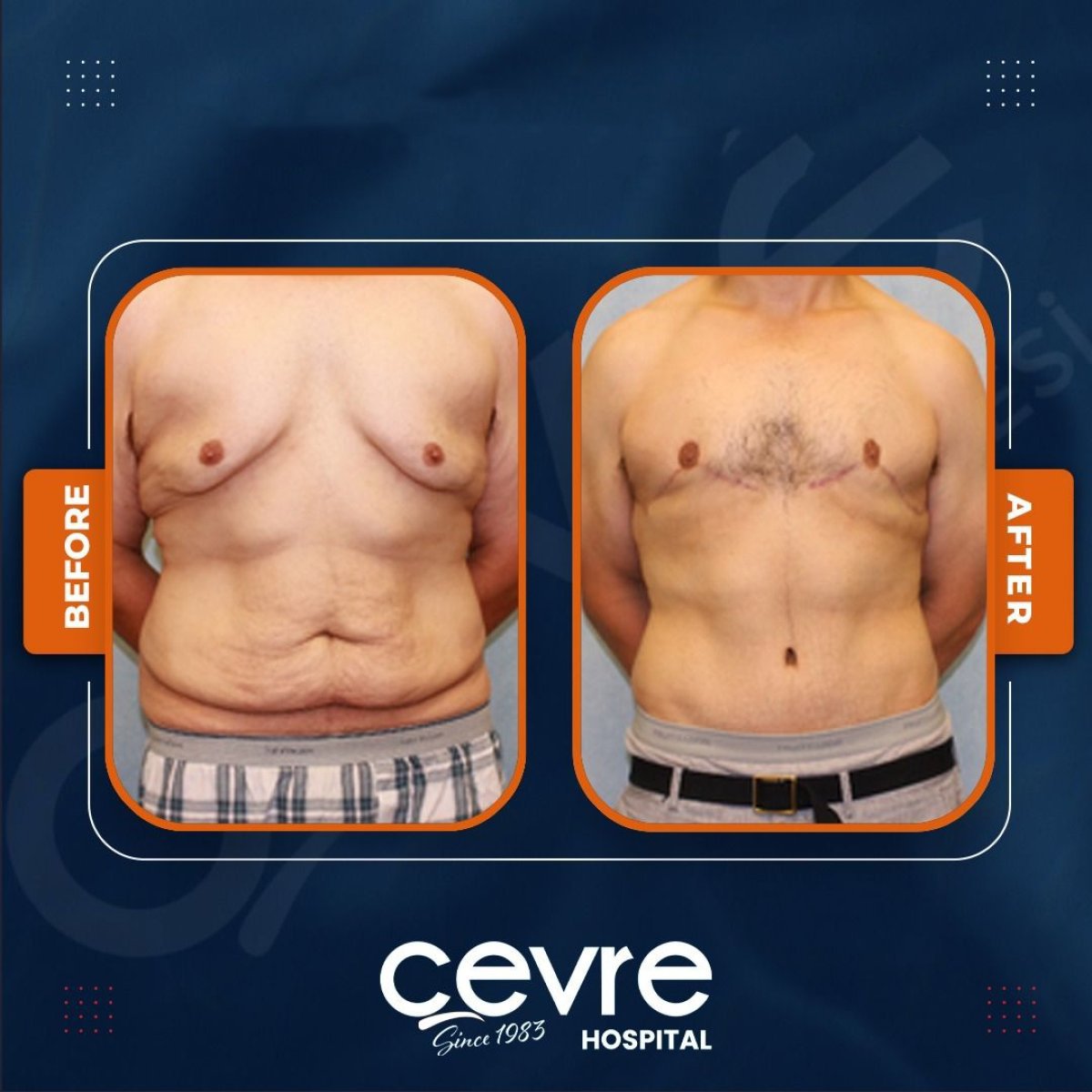 Resultados de abdominoplastia y liposucción antes y después en Adem and Havva Medical Center