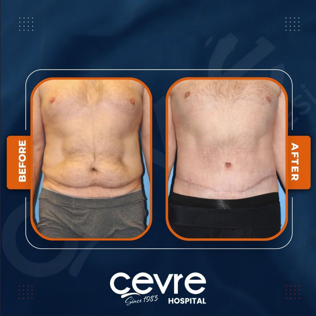 Résultats avant et après abdominoplastie et liposuccion chez Adem and Havva Medical Center
