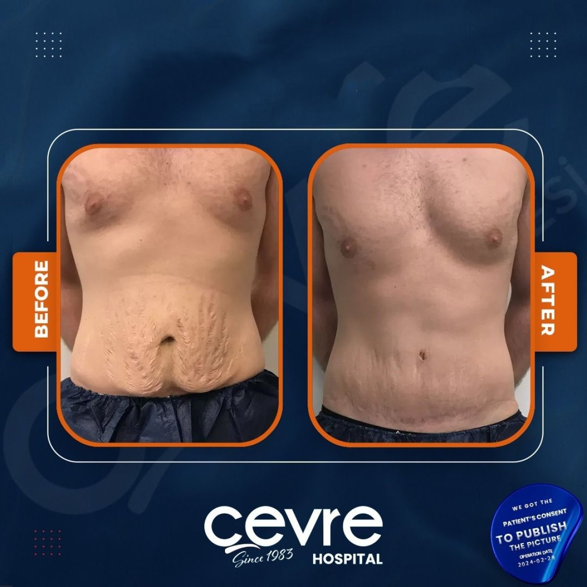 Resultados de abdominoplastia y liposucción antes y después en Adem and Havva Medical Center