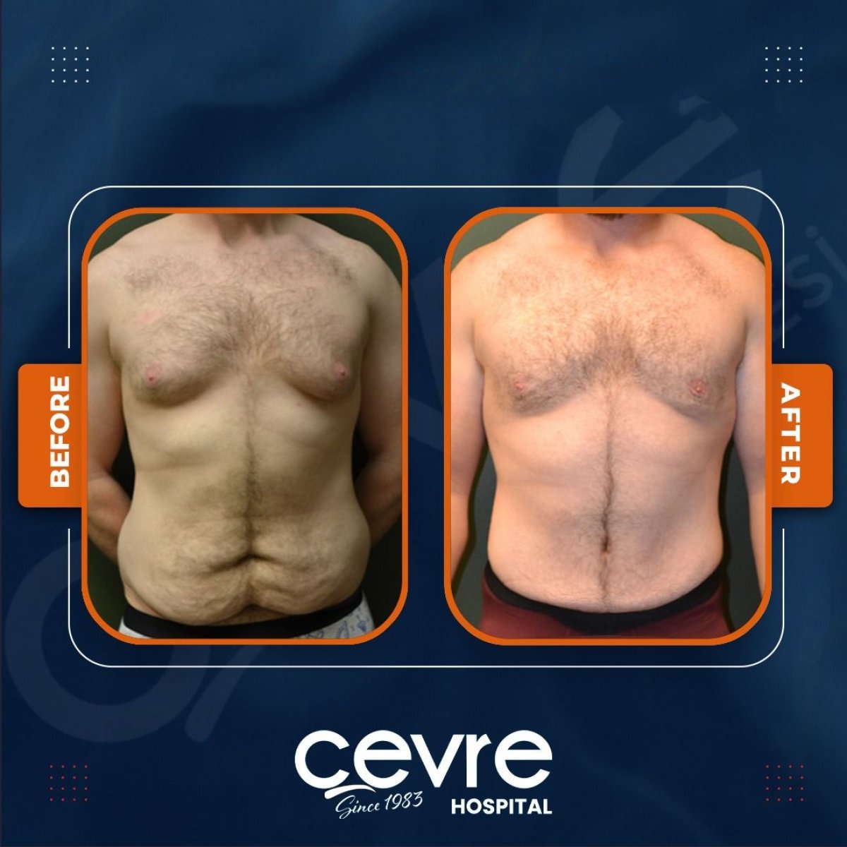 Before and after tummy tuck and liposuction results at Adem and Havva Medical Center