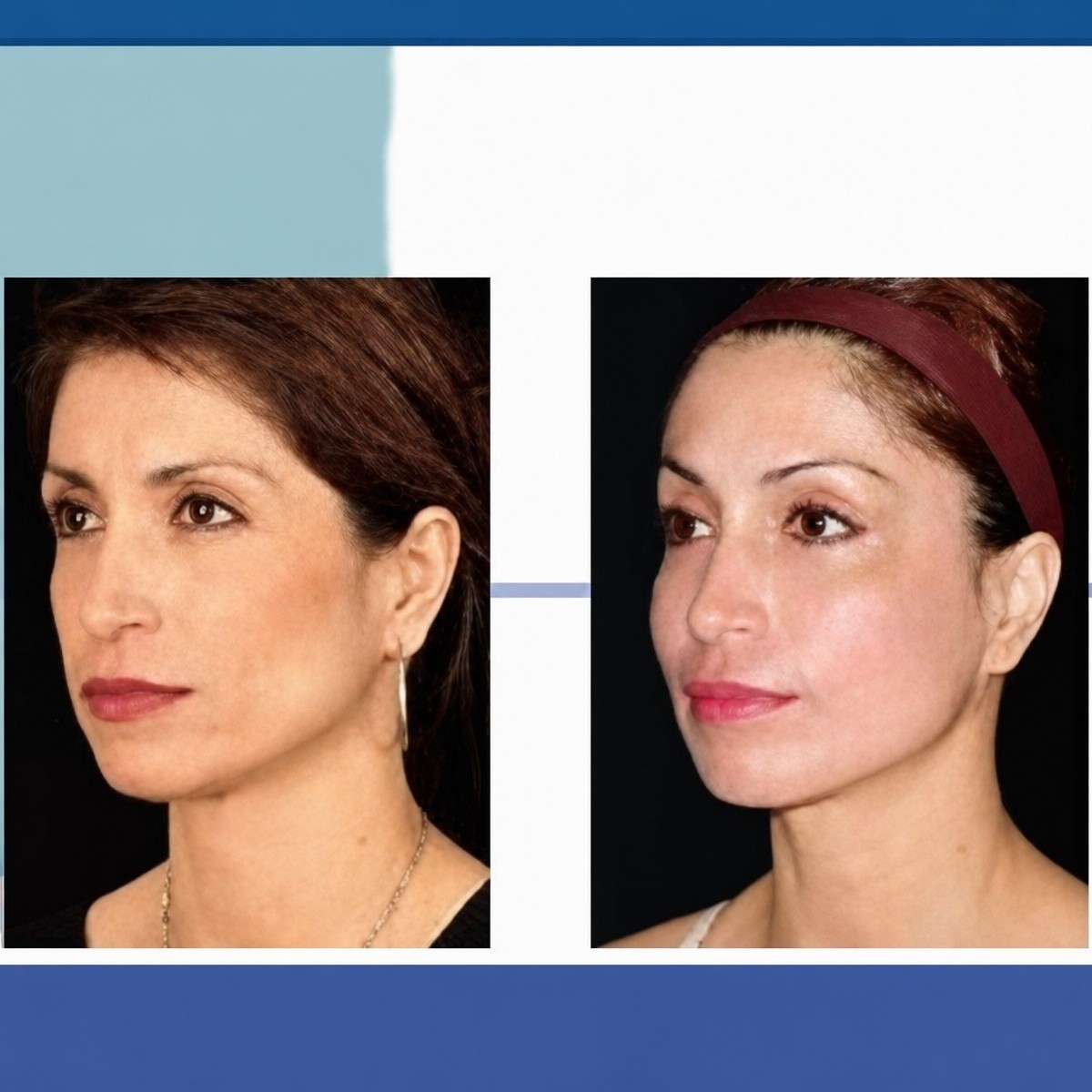 Before and after endoscopic facelift results at ID Clinic Bangkok, facial rejuvenation visible