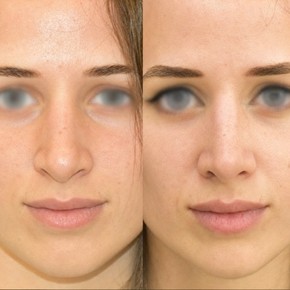 Rhinoplasty - photo 5