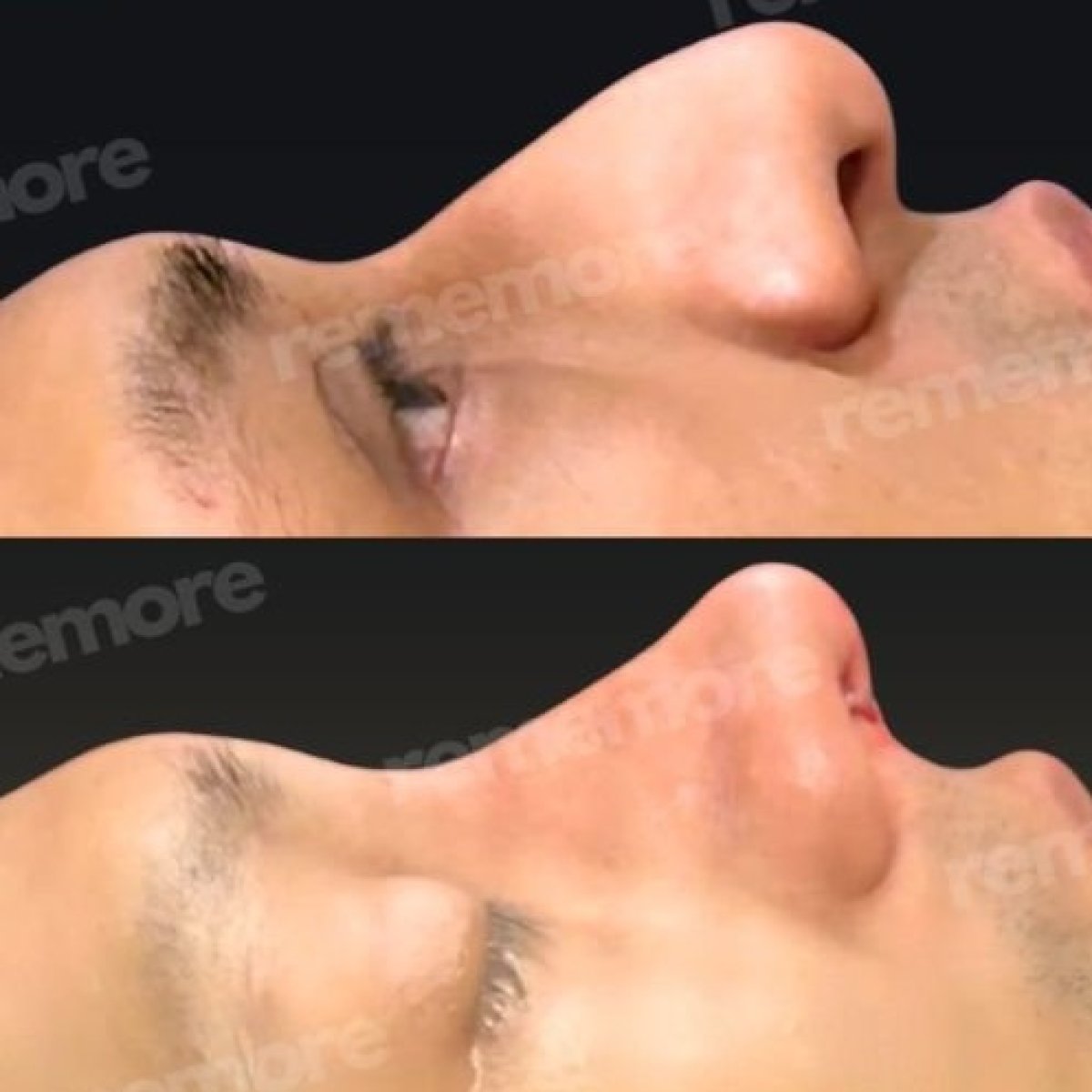 نتائج تجميل الأنف قبل وبعد في مستشفى ميموريال غوزتيبي، تحسين شكل الأنف