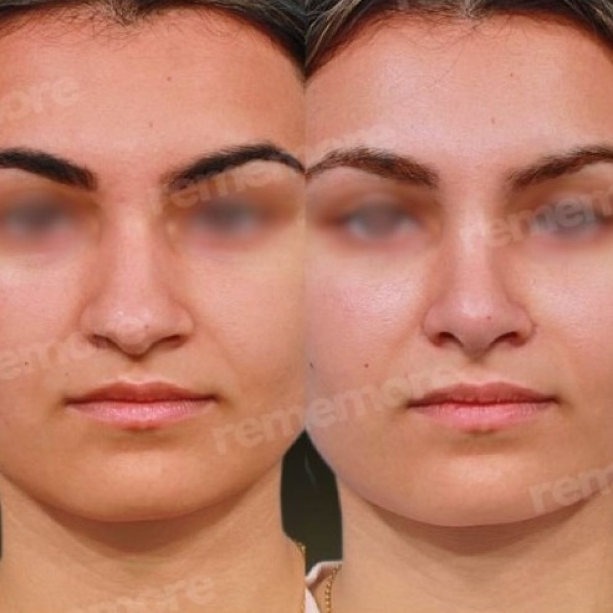 نتائج عملية تجميل الأنف قبل وبعد في مستشفى ميموريال غوزتيبي، إعادة تشكيل الأنف