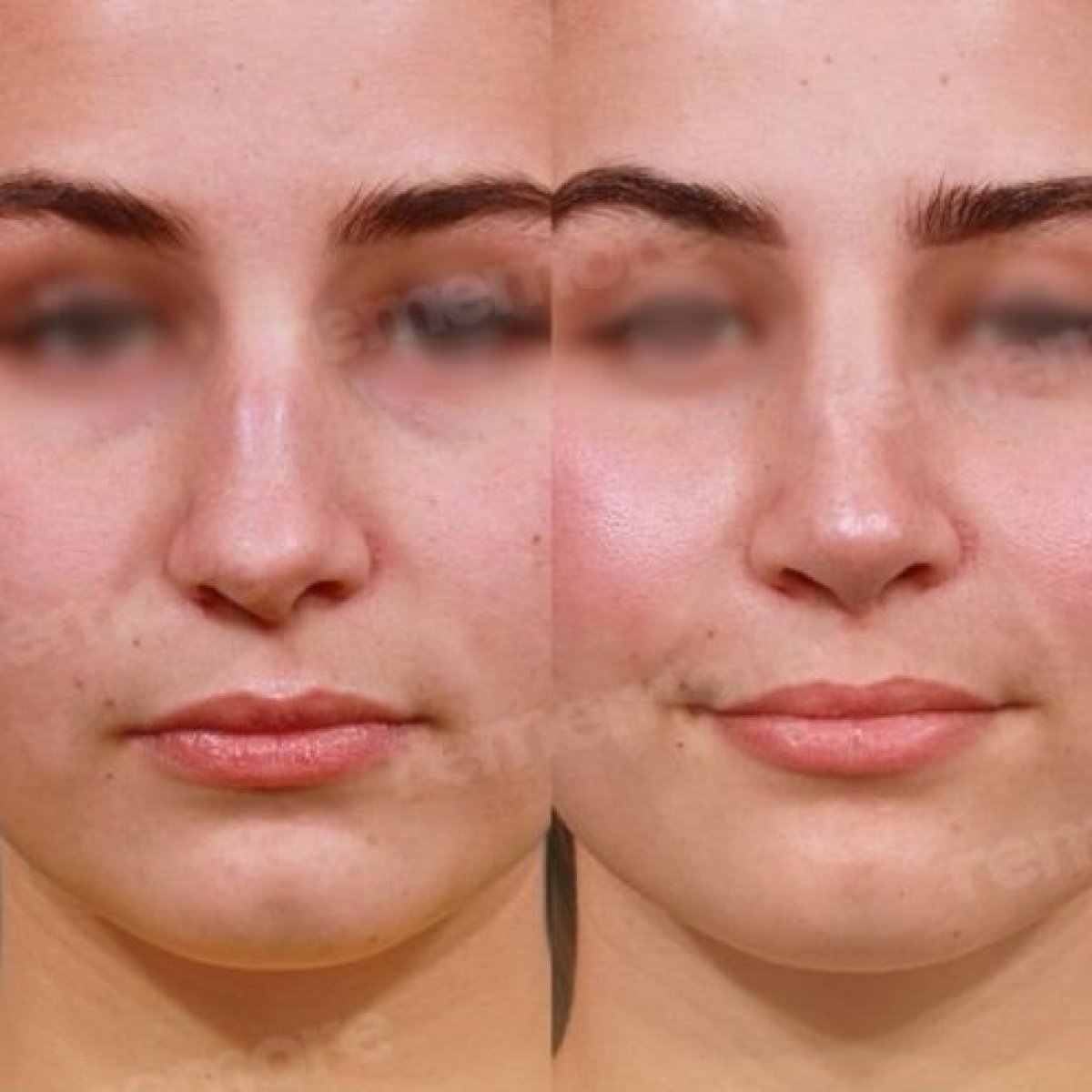 نتائج عملية تجميل الأنف قبل وبعد في مستشفى ميموريال غوزتيبي، تحسين شكل الأنف