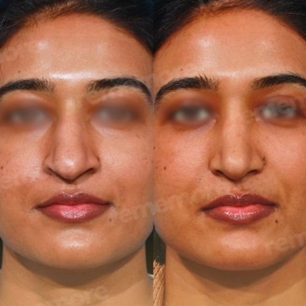 نتائج تجميل الأنف قبل وبعد في مستشفى ميموريال غوزتيبي، إعادة تشكيل الأنف