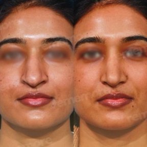 Rhinoplasty - photo 4