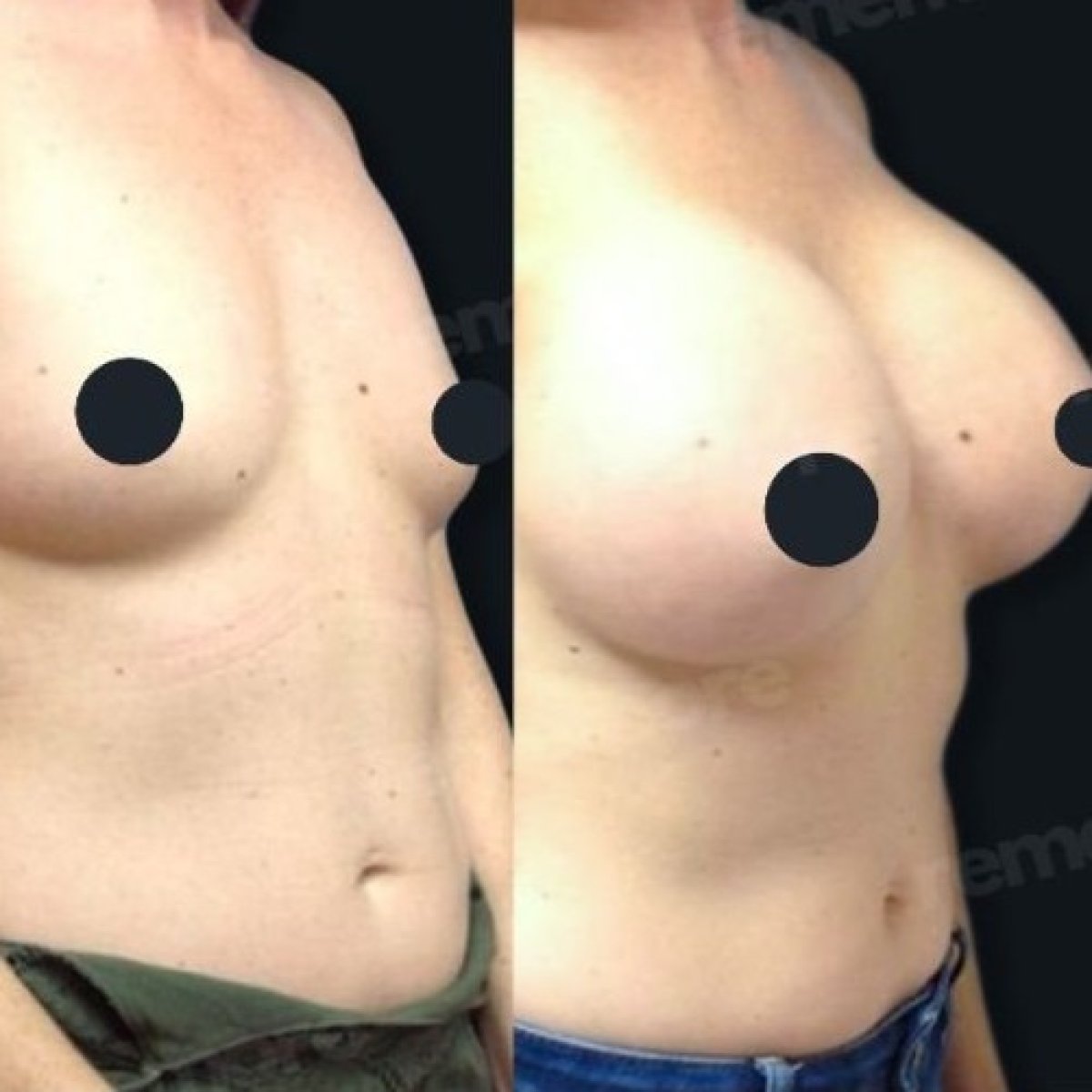 Before and after breast augmentation results at Memorial Göztepe Hospital, enhanced volume