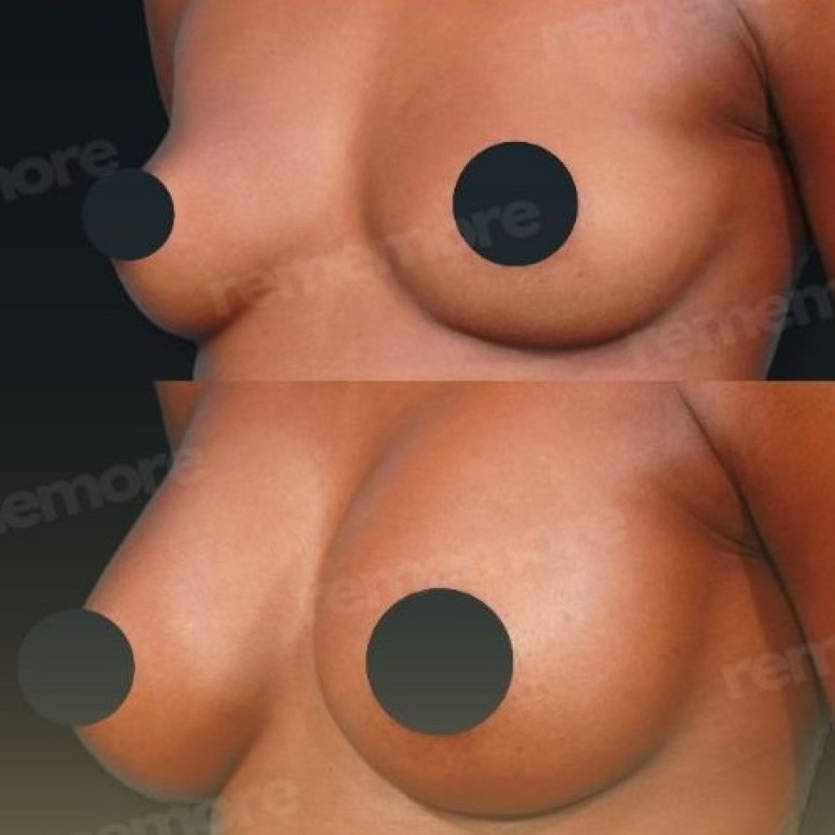 Before and after breast augmentation results at Memorial Göztepe Hospital, fuller breast shape
