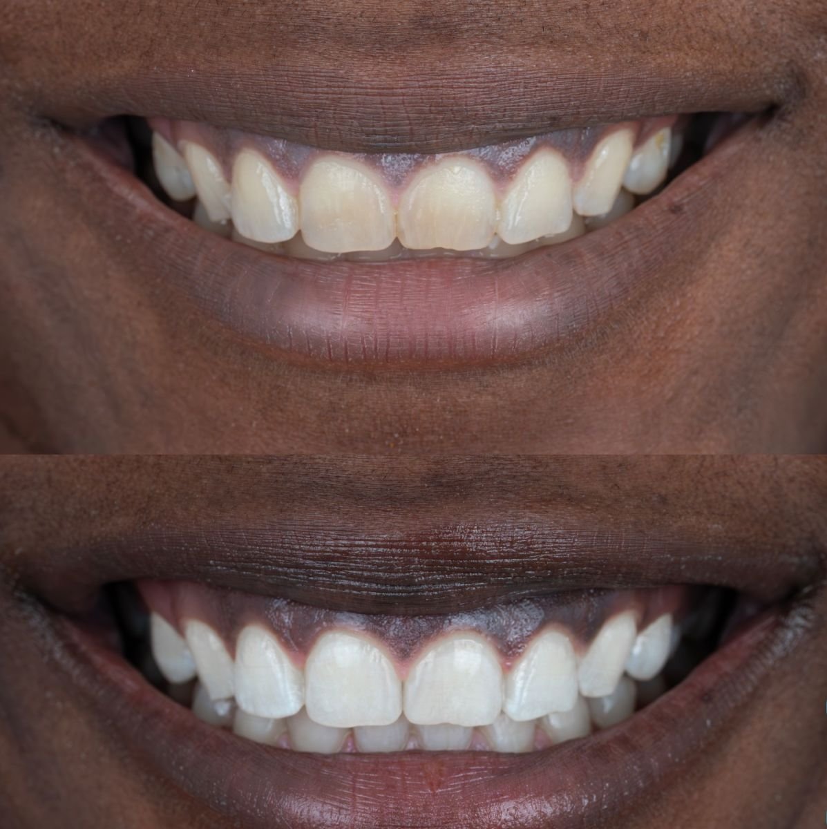 Before and after teeth cleaning results at Adem and Havva Medical Center, whiter smile