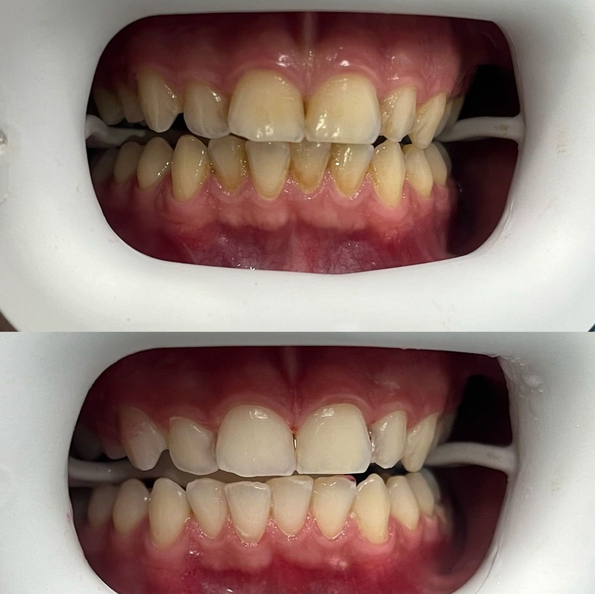 Resultados antes y después de limpieza dental (scaling) en Adem and Havva Medical Center