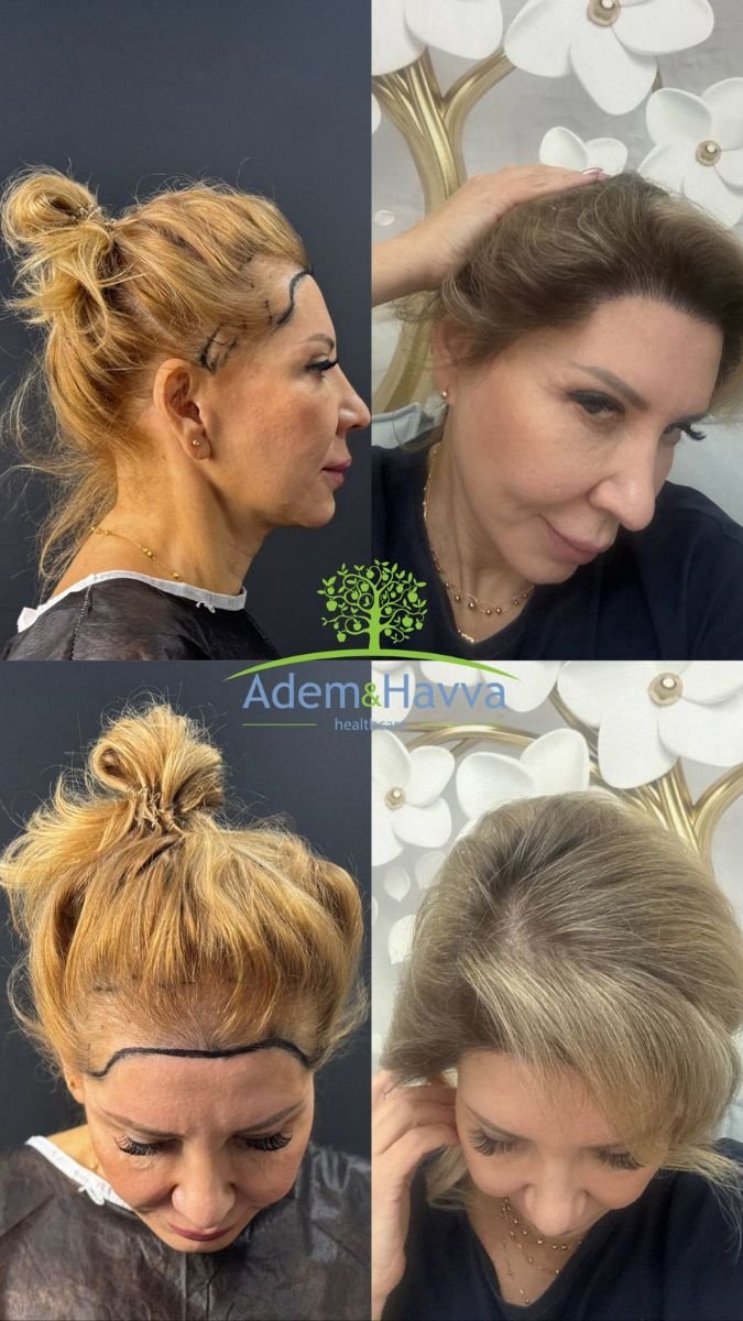 Female hair transplant before and after results at Adem and Havva Medical Center, fuller hairline