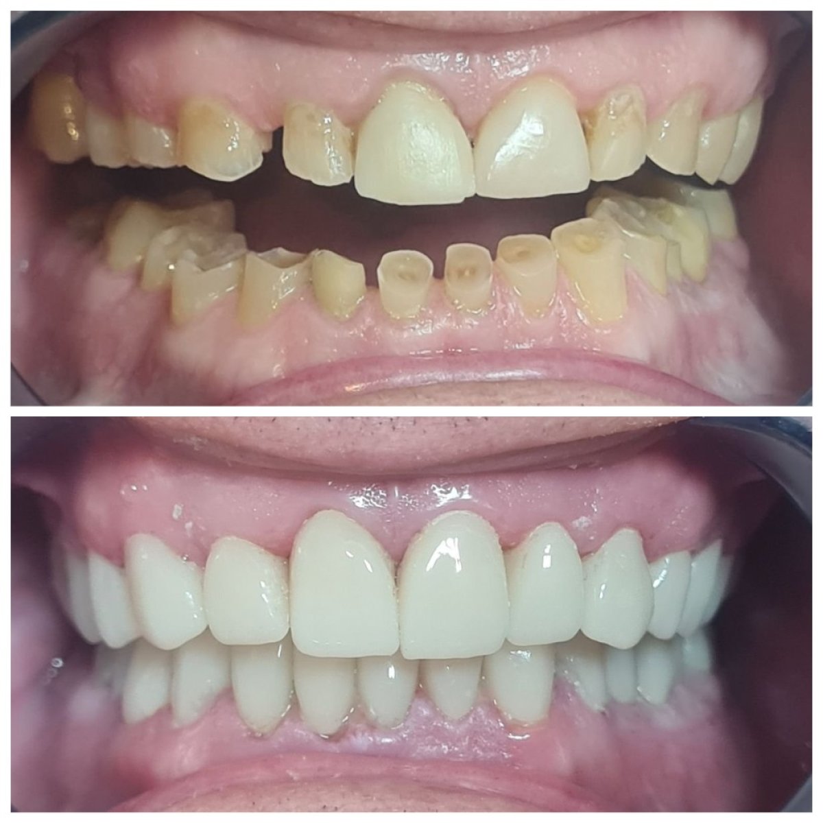 До и после установки циркониевых коронок в SoftDentalCare Clinic, результат улыбки
