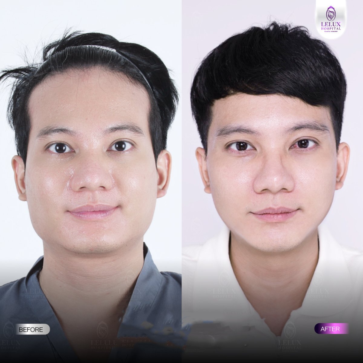 Avant et après réduction des pommettes à Lelux Hospital, résultat visible du remodelage facial