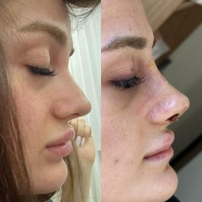 Rhinoplasty - photo 6