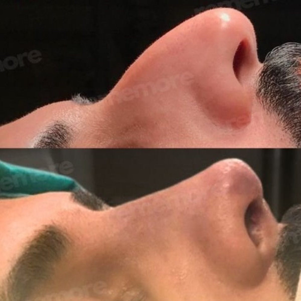 نتائج تجميل الأنف التصحيحي قبل وبعد في مستشفى ميموريال غوزتيبي، تحسين شكل الأنف