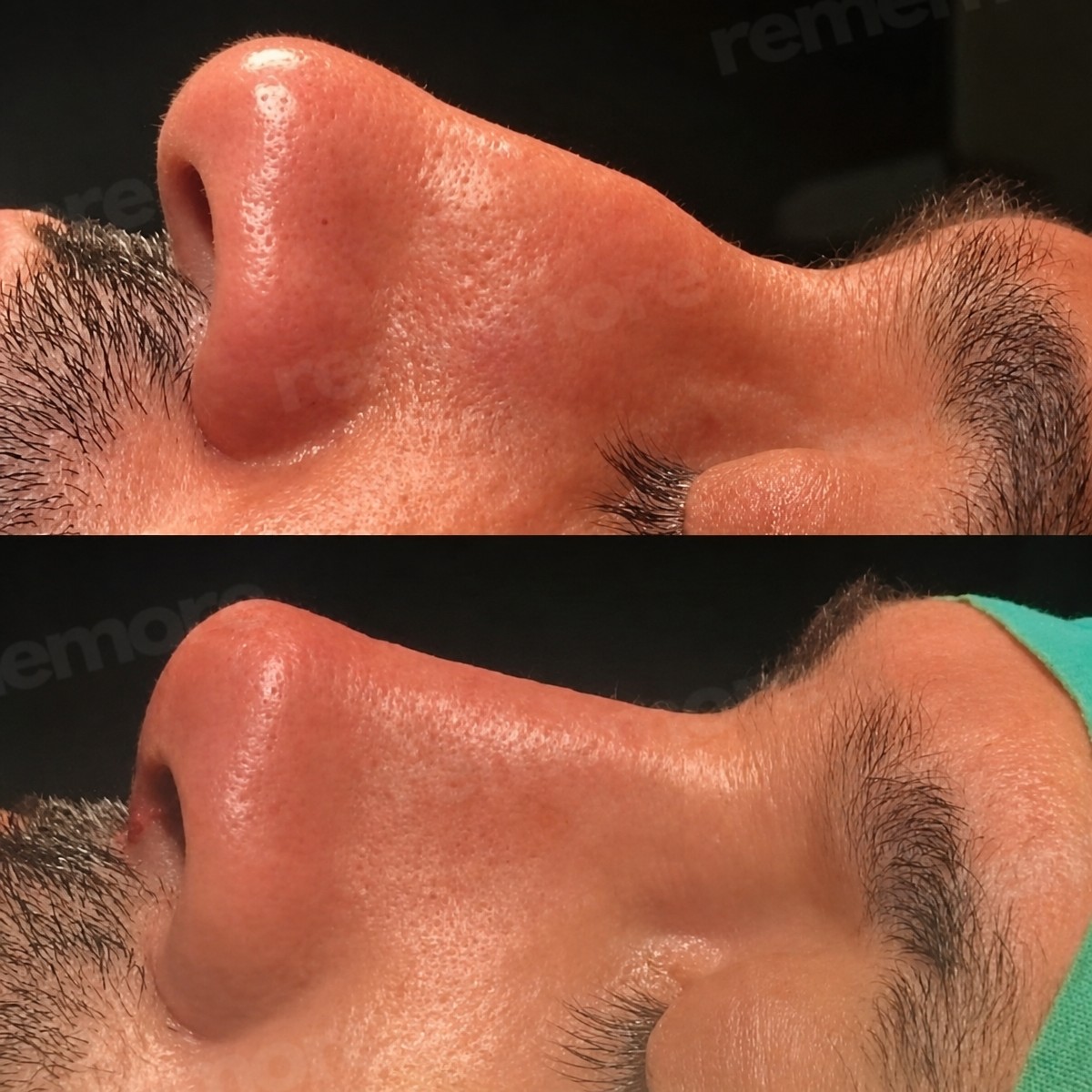 Before and after revision rhinoplasty result at Memorial Göztepe Hospital, improved nose shape