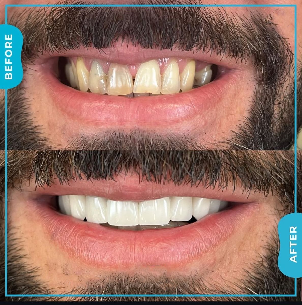 نتائج تنظيف الأسنان قبل وبعد في Adem and Havva Medical Center، ابتسامة أكثر إشراقًا