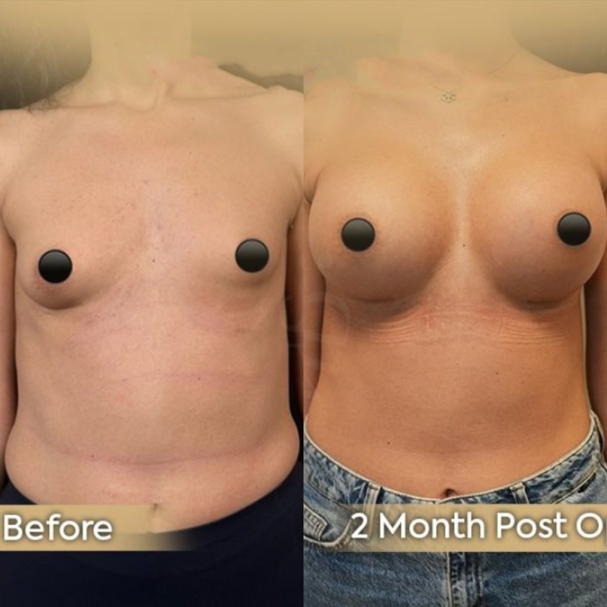 Before and after breast augmentation with fat transfer results at Dr. Safa Manav Clinic