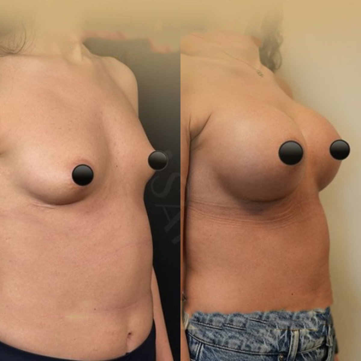 Before and after breast augmentation with fat transfer results at Dr. Safa Manav Clinic