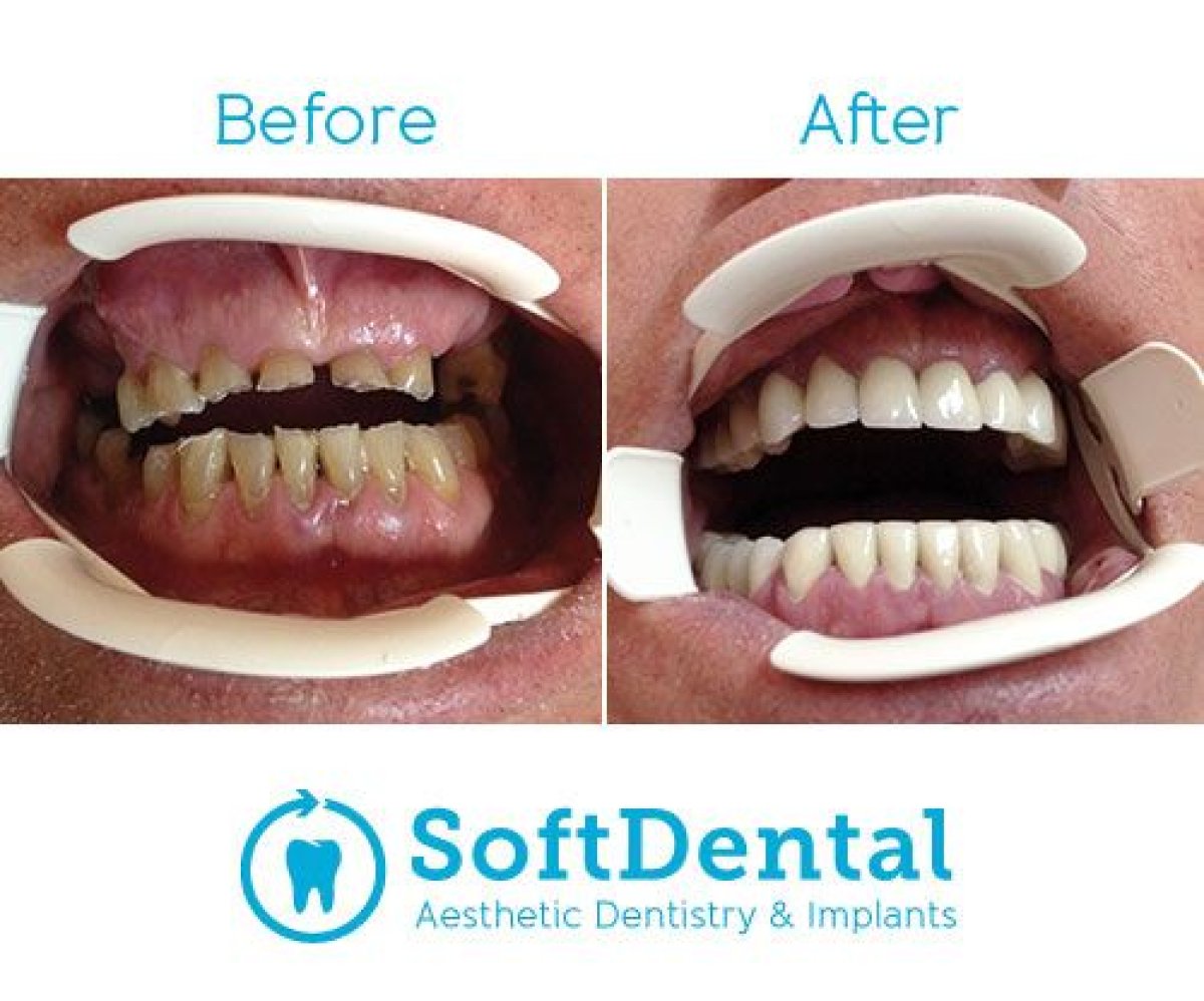 Résultats avant/après bridge dentaire zircone chez SoftDentalCare Clinic, sourire restauré