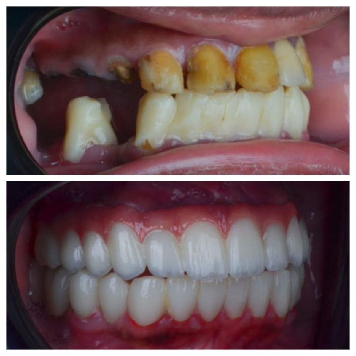 Результат до и после имплантации All-on-4 в Omara Dental Centers, полное восстановление улыбки