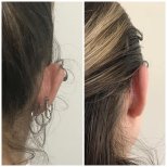 صور قبل وبعد جراحة الأذن (انظر. تجميل الأذن) للدكتور Sinan Eroglu