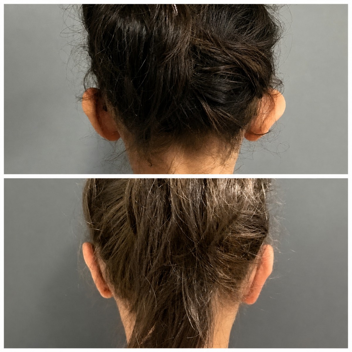 Before and after otoplasty results at Op. Dr. Sinan Eroglu Clinic, ear reshaping surgery