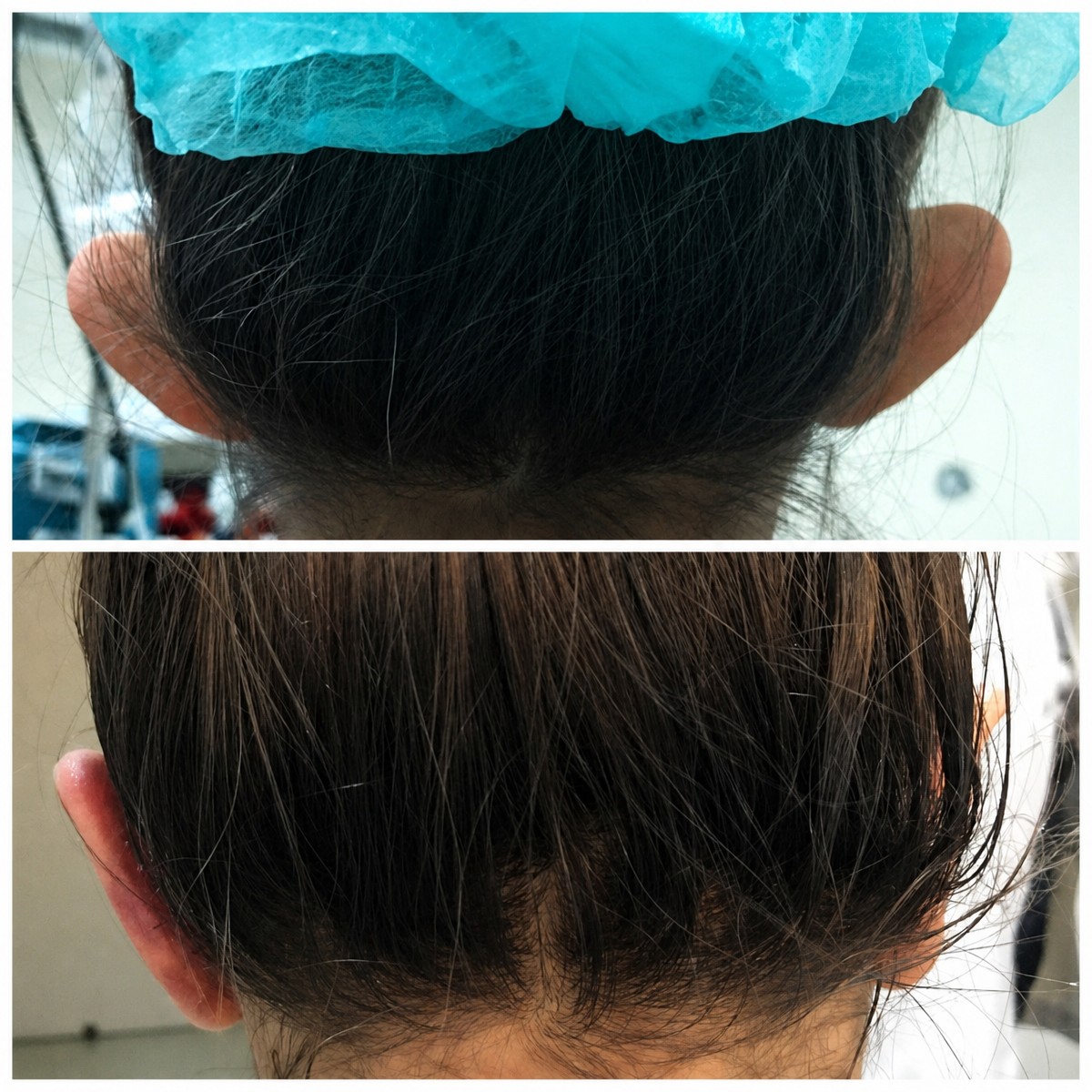 نتائج عملية تجميل الأذن قبل وبعد في عيادة Op. Dr. Sinan Eroglu، تصحيح الأذن