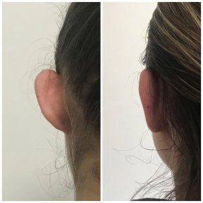 Otoplasty for Balanced Facial Profile — 2 Nights Hotel & VIP Transfer - photo 4