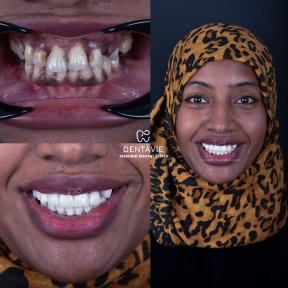 All-on-4 Implants with 24 Zirconia Crowns by Straumann Official Provider - photo 5