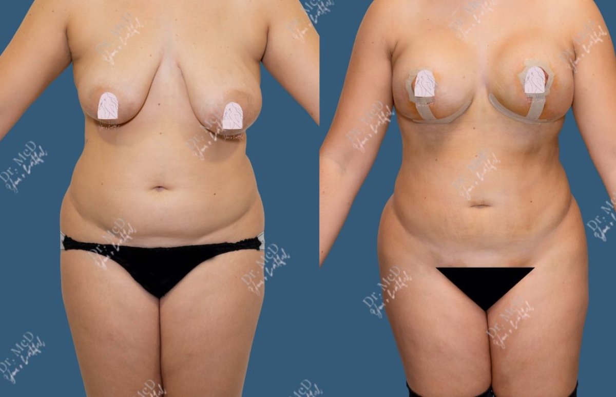 Antes y después de implantes mamarios con lifting en Dr. MED, resultados mejorados
