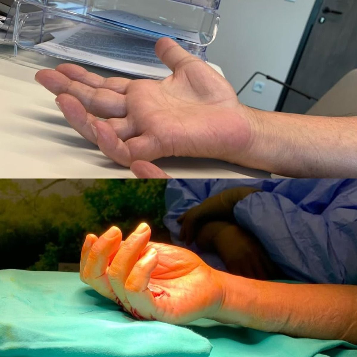 Resultados de cirugía reconstructiva de mano antes y después en Memorial Bahçelievler Hospital