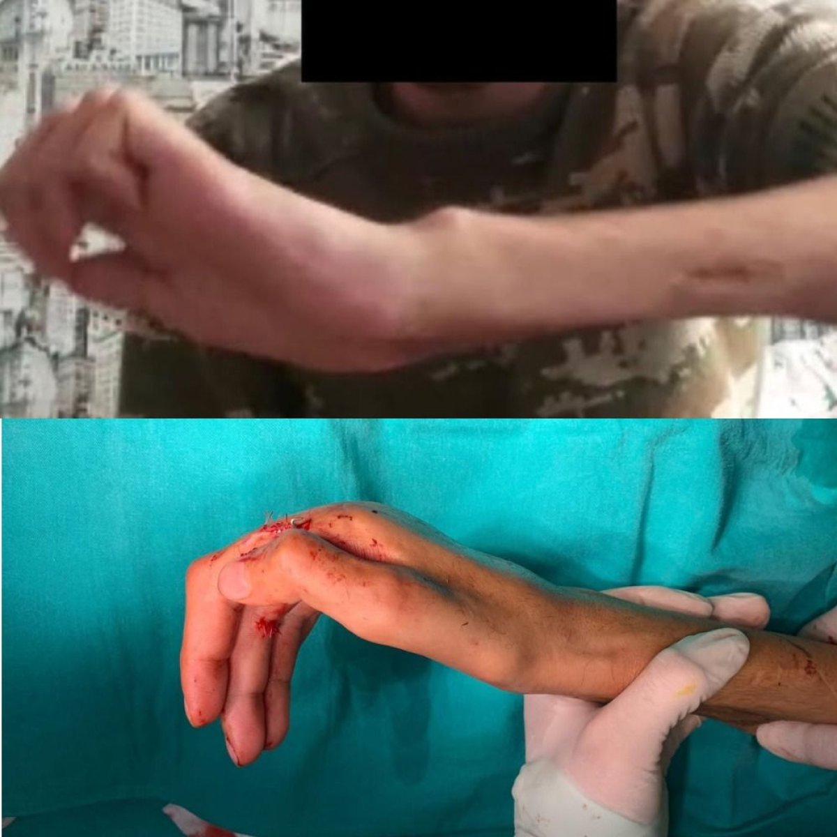 Resultados de cirugía reconstructiva de mano antes y después en Memorial Bahçelievler Hospital
