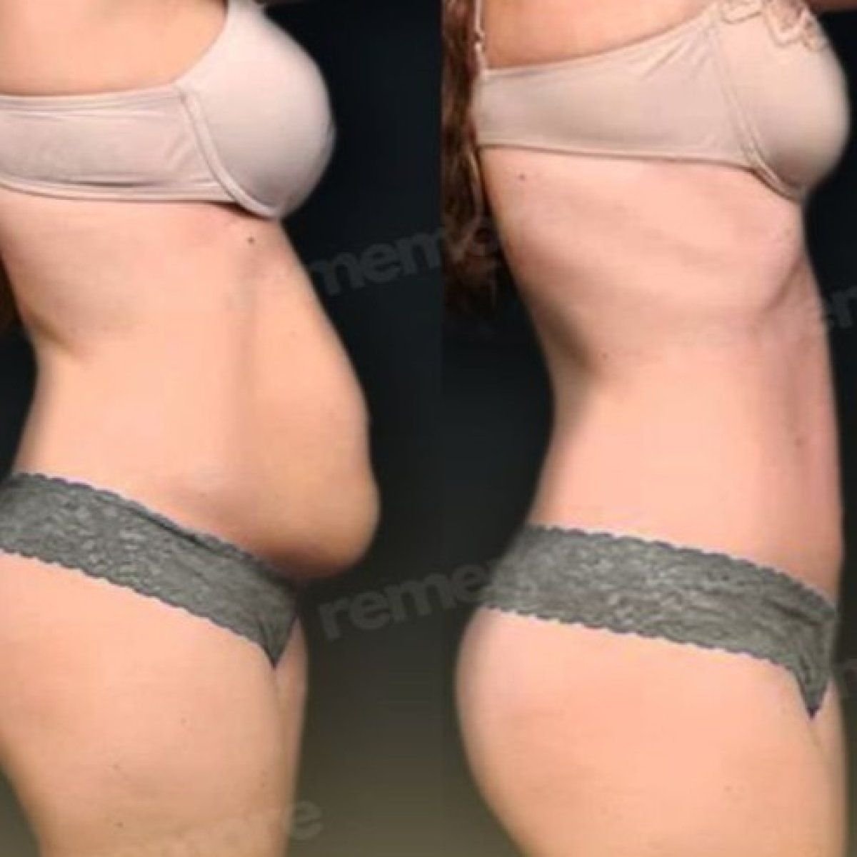 Before and after tummy tuck and liposuction results at Memorial Antalya Hospital, flatter abdomen